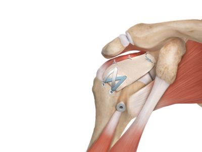 Rotator Cuff Repair & Frozen Shoulder Treatment—Why Choose Dr. Karnav Panchal