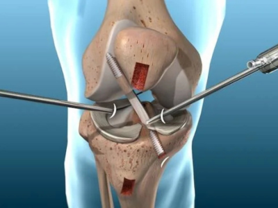 Why Dr. Karnav Panchal Is Ahmedabad’s Leading Knee Arthroscopy Surgeon