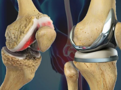Affordable Knee Replacement Surgery in Ahmedabad Without Compromising Quality