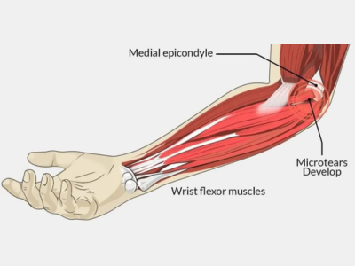 Golfer’s Elbow Pain Treatment in Ahmedabad/Gujarat