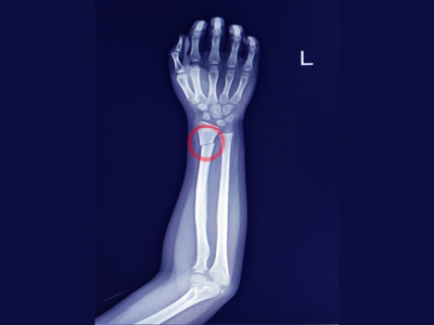 Fracture and poly trauma patient management treatment in ahmedabad