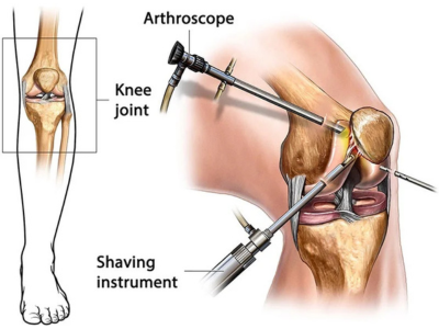 Ahmedabad Sports Injury Specialist – ACL, Meniscus, Shoulder & Elbow Arthroscopy by Dr. Karnav Panchal