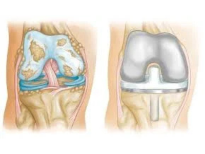 Best Knee Replacement Surgeon in Ahmedabad – Cost, Recovery & Results