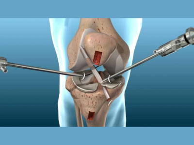 Best Sports Injury Doctor in Ahmedabad for ACL, Meniscus & Ligament Tears