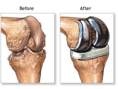 Knee Replacement in Ahmedabad: What to Expect Before and After Surgery
