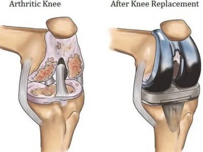 How Much Does Knee Replacement Cost in Ahmedabad in 2025?