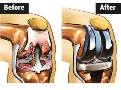 Knee joint preservation – Why and How?