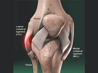 LCL Injury Treatment in Ahmedabad/Gujarat