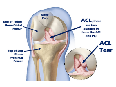 ACL Injury Treatment in Ahmedabad/Gujarat