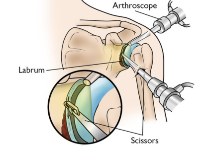 SLAP Tear Shoulder Treatment in Ahmedabad / Gujarat
